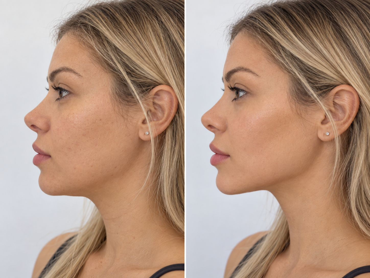 Harmonização facial