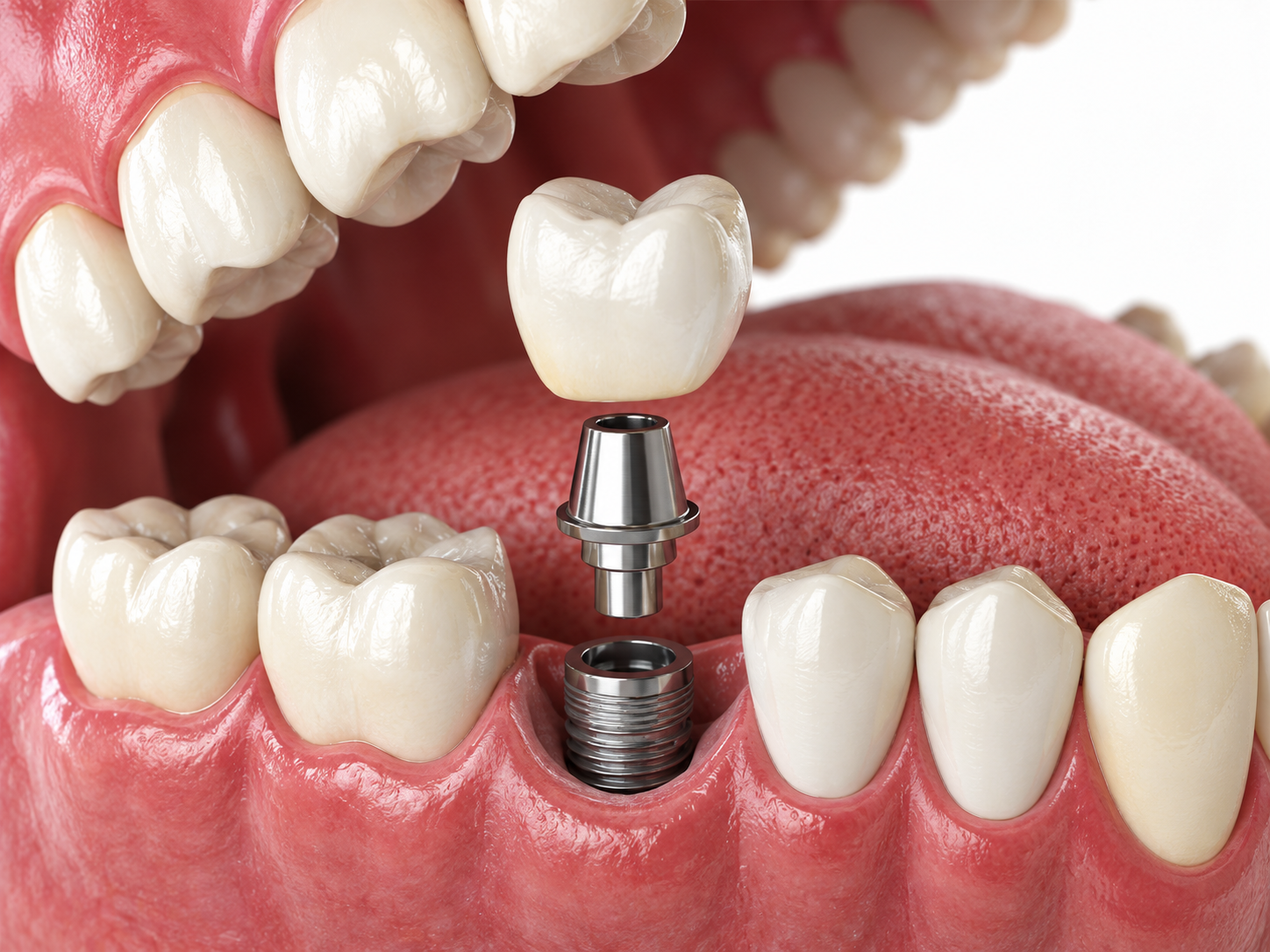 Implantes dentários