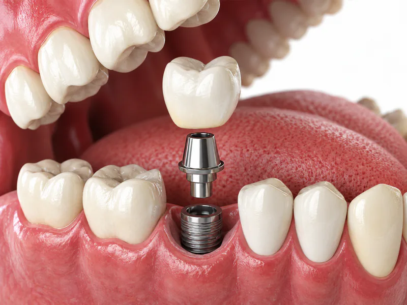 Implantes dentários